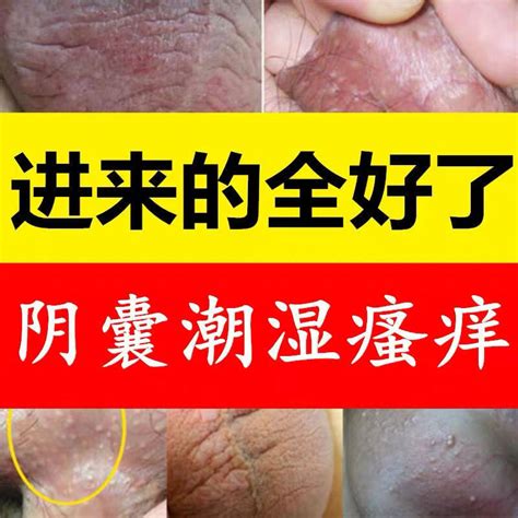 男生的龜頭|小弟弟出事了！龜頭又紅又癢怎麼辦？龜頭炎6大症狀。